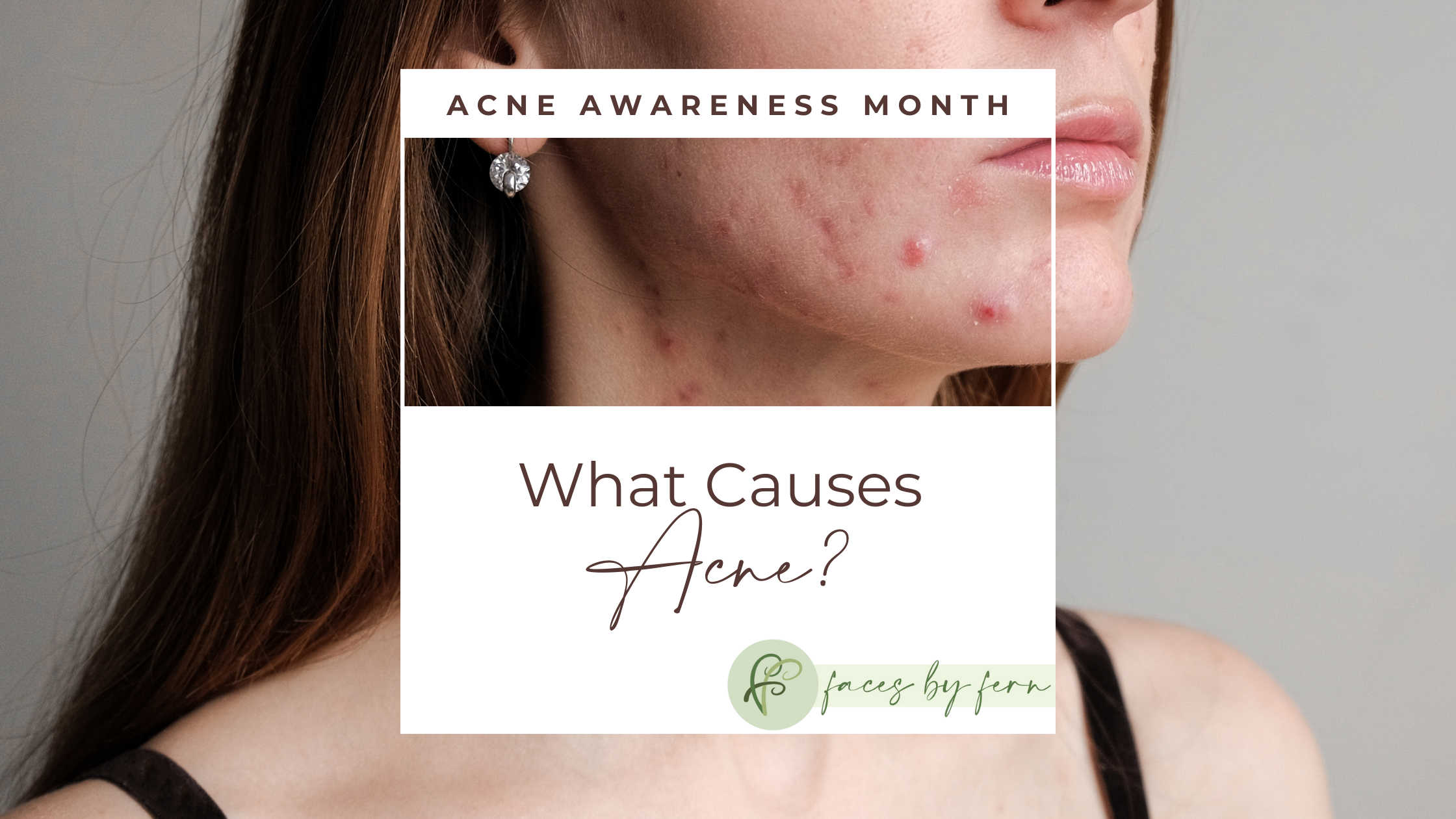 What Causes Acne?