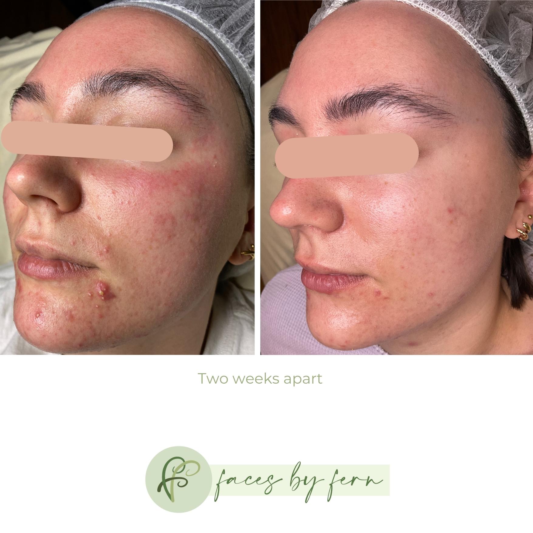 This image depicts the change in a client&#39;s skin after only one facial then two weeks using this gentle acne starter kit.