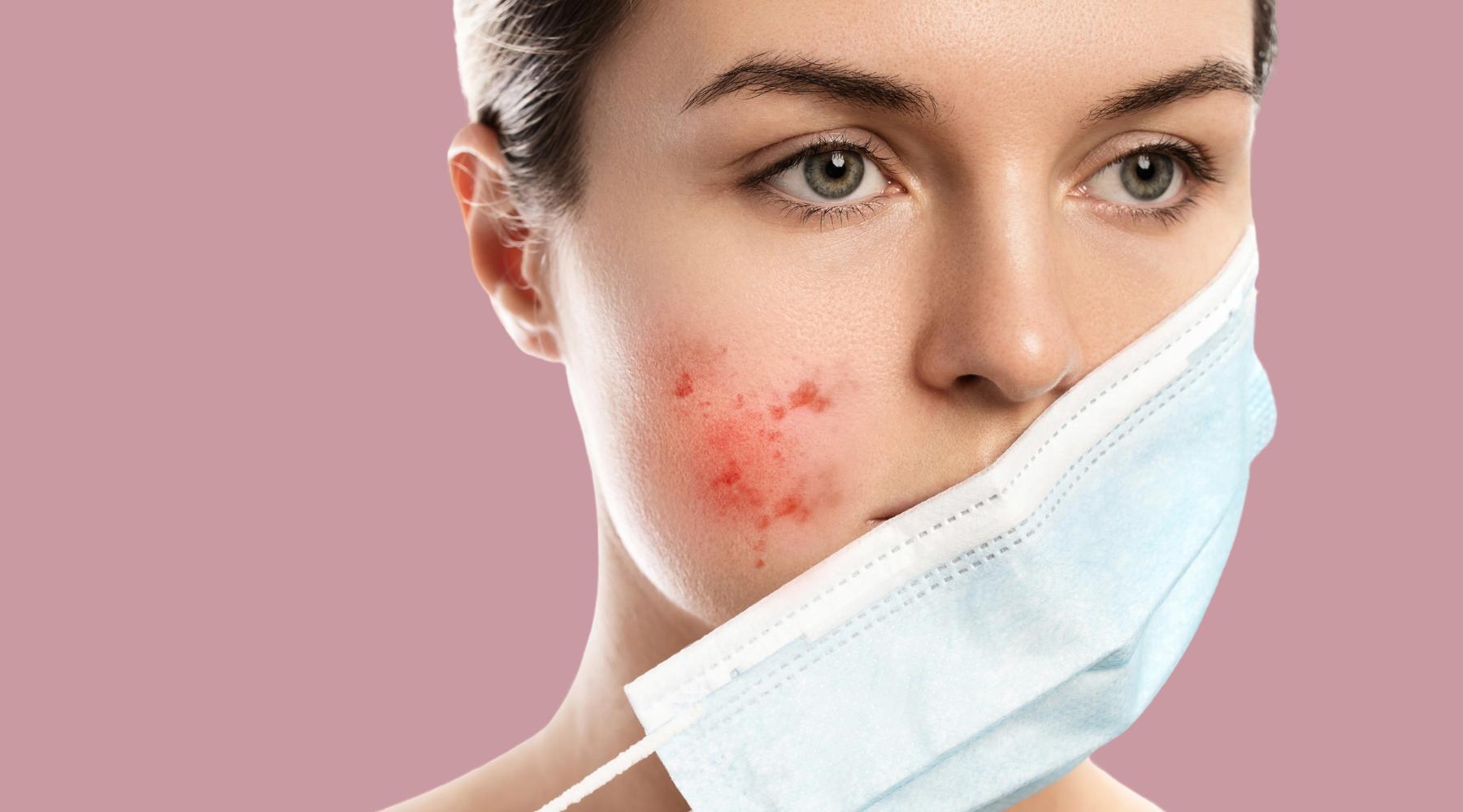 How to Prevent Maskne