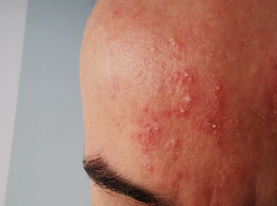 April is Acne Rosacea Awareness Month