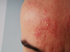 April is Acne Rosacea Awareness Month