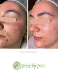 This image depicts the change in a client's skin after only one facial then two weeks using this gentle acne starter kit.